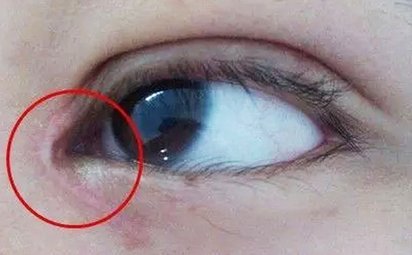 內眼角修復難不難？哪些情況需要修復?