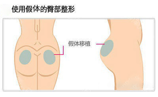 假體豐臀多少錢？假體豐臀效果是永久的嗎？