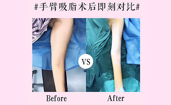 手臂吸脂會(huì)反彈嗎？