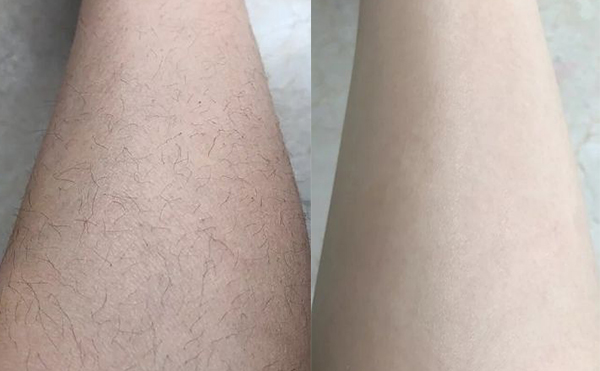 冰點(diǎn)脫腿毛效果怎么樣？