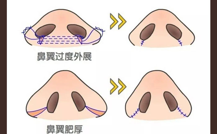 鼻頭肥大怎么改善？鼻頭肥大矯正術(shù)多少錢？