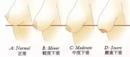 產(chǎn)后胸部下垂怎么辦?