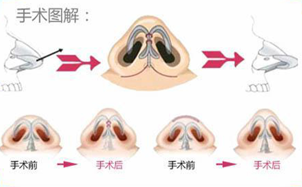 鼻翼縮小手術(shù)過程