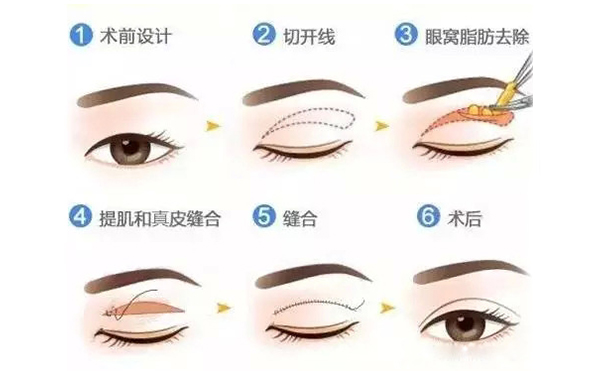 全切雙眼皮跟埋線的區(qū)別是什么？哪個(gè)好？