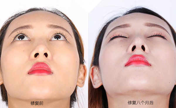 隆鼻手術(shù)失敗怎么辦？修復(fù)費用要多少？