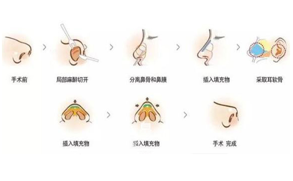 耳軟骨隆鼻效果怎么樣？要多少錢？