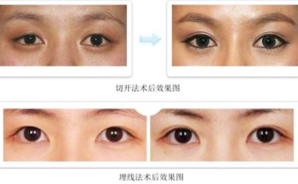雙眼皮埋線和切開(kāi)哪個(gè)比較好?疼痛程度有什么不同？