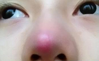 術(shù)后鼻頭發(fā)紅是隆鼻手術(shù)失敗了嗎？該怎么處理？