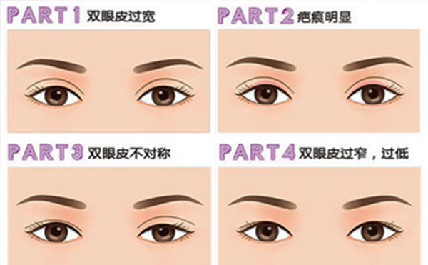 雙眼皮失敗有哪些明顯表現(xiàn)？修復(fù)成功率大嗎？