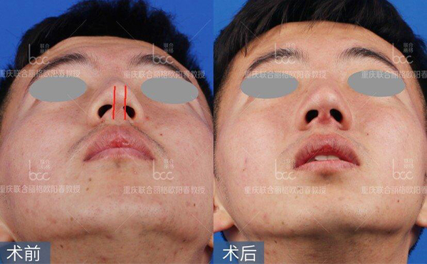 歪鼻修復術要多少錢？