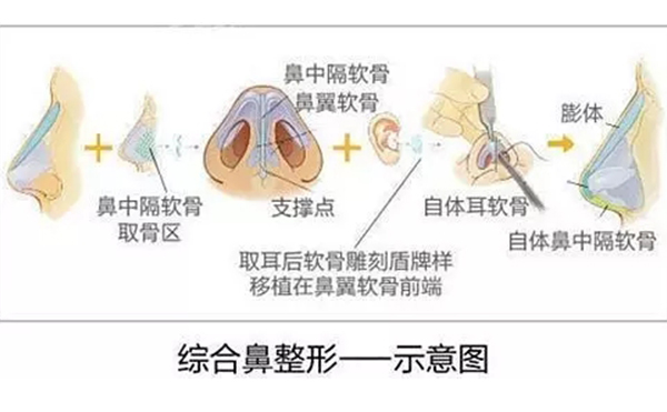 鼻綜合整形的效果怎么樣？鼻綜合手術(shù)安全嗎？