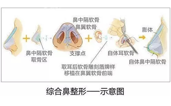 為什么都建議做鼻綜合手術(shù)？
