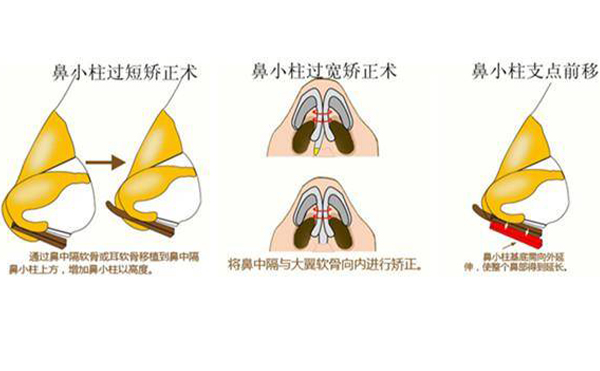鼻小柱缺損修復(fù)有幾種方法？為什么會出現(xiàn)鼻小柱缺損的情況