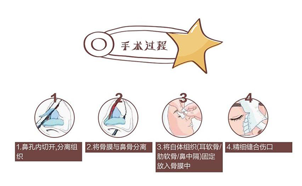 自體軟骨隆鼻為什么這么受歡迎？