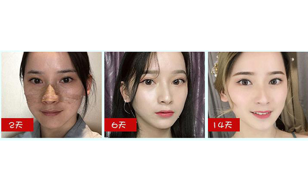 全肋鼻和半肋鼻有什么區(qū)別？做全肋好還是半肋好