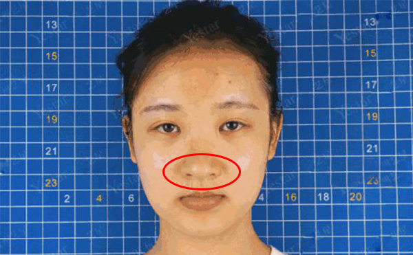 鼻頭肥大是什么原因造成的？怎么解決鼻頭肥大