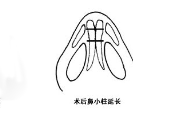 鼻小柱延長可靠嗎？手術(shù)難度大嗎