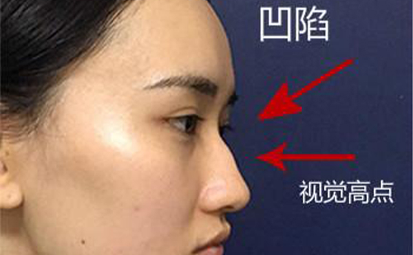 駝峰鼻整形是怎么做的？不同嚴(yán)重程度的駝峰鼻矯正方法一樣嗎？