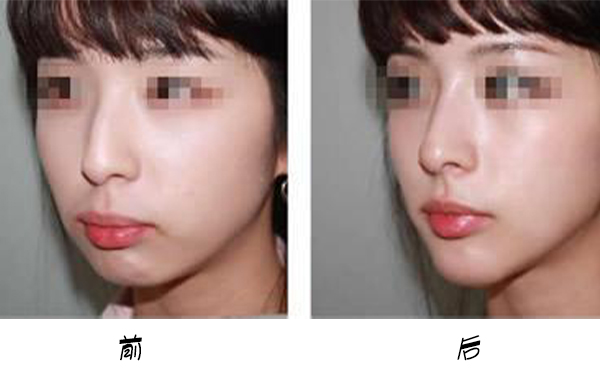 箭鼻是怎么出現(xiàn)的?箭鼻矯正是如何操作的？
