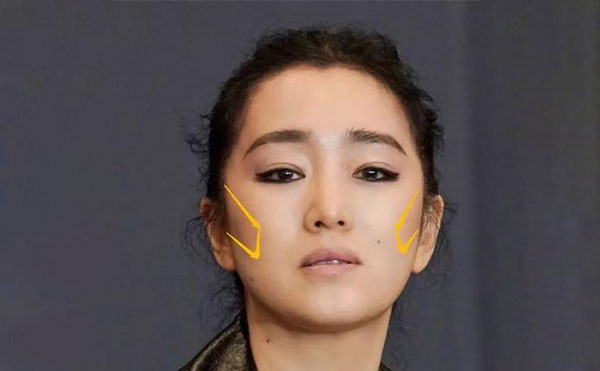 什么原因?qū)е嘛E骨外擴？