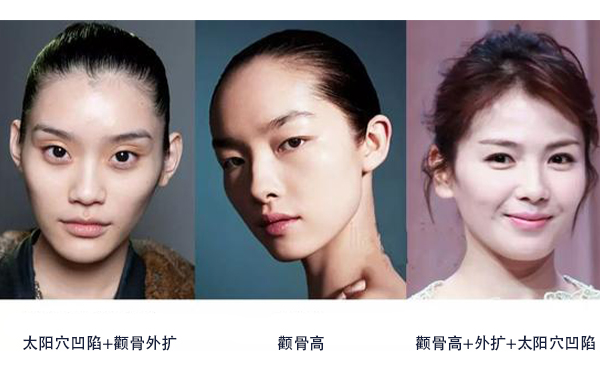 怎么區(qū)分是顴骨高還是太陽穴凹陷？