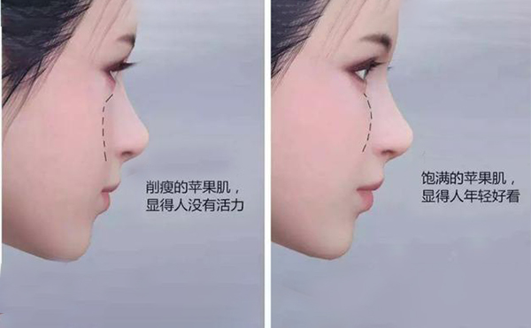 蘋果肌凹陷怎么辦？
