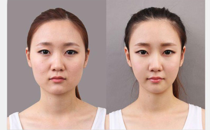 非手術(shù)瘦臉多少錢？非手術(shù)瘦臉方法有哪些？