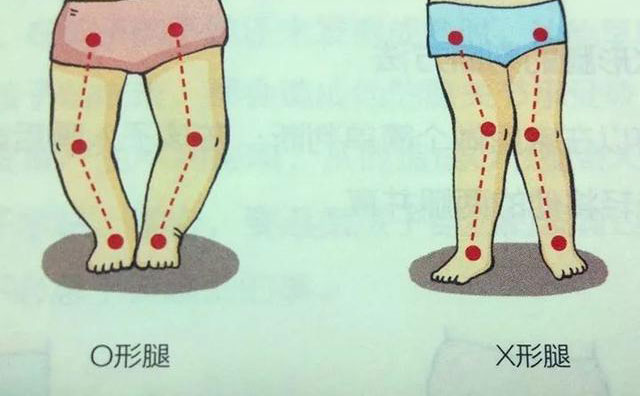 羅圈腿怎樣矯正？羅圈腿手術(shù)矯正多少錢(qián)？