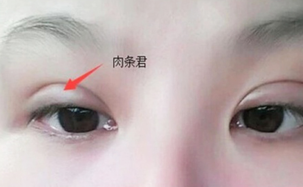 雙眼皮不自然怎么補救？雙眼皮肉條好修復(fù)么？