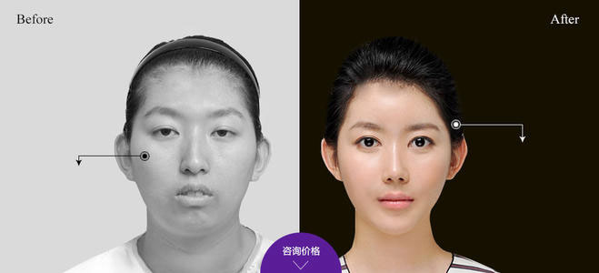 下頜角整形的方法有哪些？