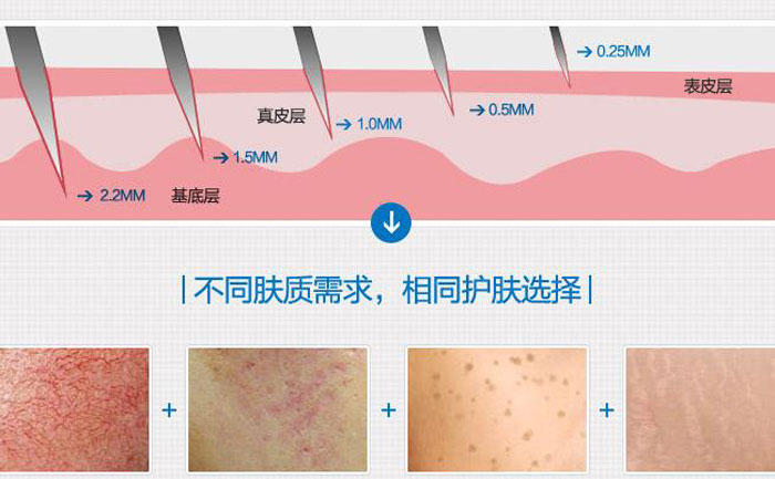 微針去痘坑多少錢一次？