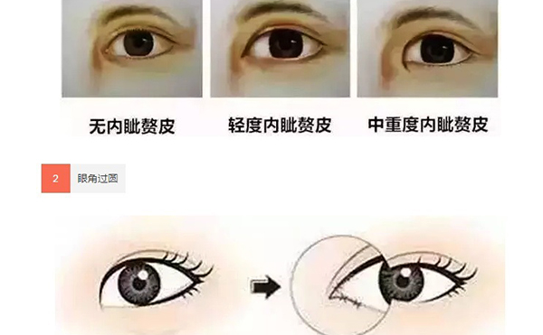 單眼皮可以只開(kāi)眼角嗎?效果怎么樣?
