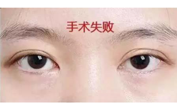 韓式三點(diǎn)雙眼皮的優(yōu)點(diǎn)是什么?術(shù)后怎么避免不對(duì)稱?