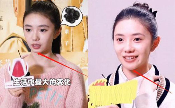 玻尿酸隆下巴整形攻略【優(yōu)勢(shì)、適宜人群、注意事項(xiàng)】