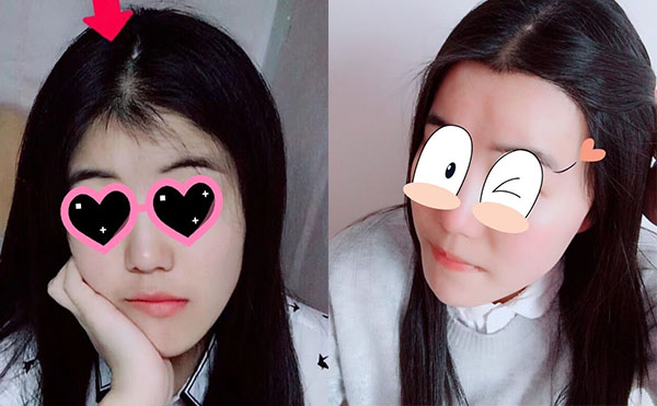 冰點脫毛發(fā)際線怎么樣？