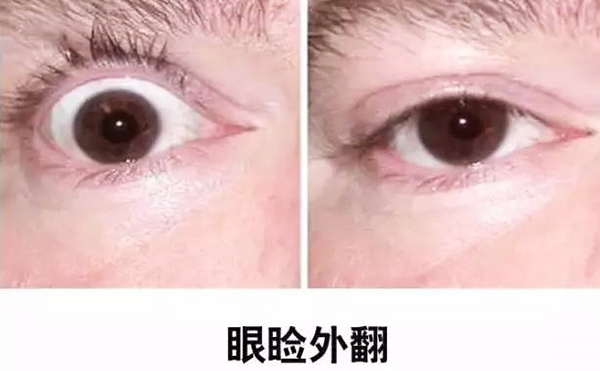 醫(yī)美技術(shù)越來越發(fā)達(dá)，不少愛美的人本著變美的心情滿懷期待地去做雙眼皮、開眼角等項(xiàng)目，不料整容不成、反倒毀容，后悔也來不及。有些做雙眼皮的姑娘術(shù)后出現(xiàn)眼瞼外翻的情況，那眼瞼外翻是什么意思?上眼瞼外翻如何修復(fù)?
