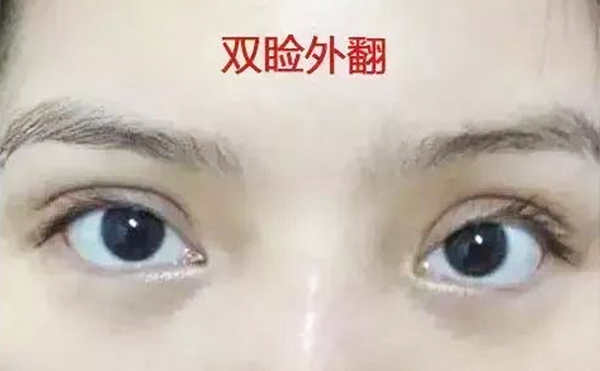 眼瞼外翻術前需要注意什么?術后怎么護理?