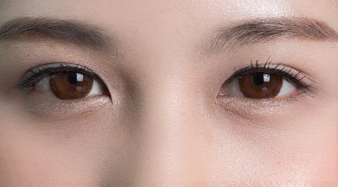 上眼皮松弛是什么原因引起的？