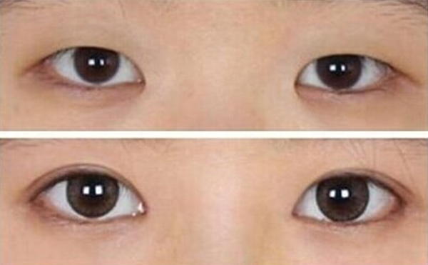 眼球突出矯正術(shù)恢復(fù)時間需要多久?術(shù)后怎么護理?