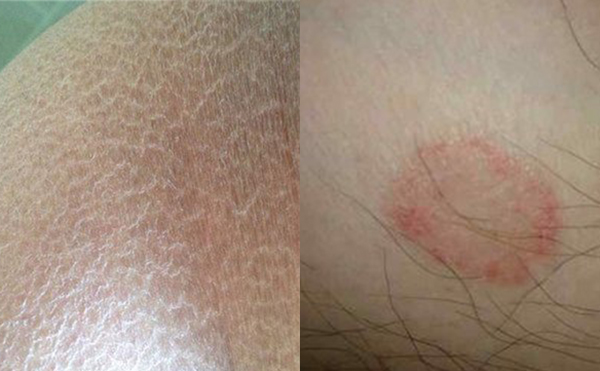 脫腋毛有什么副作用嗎？