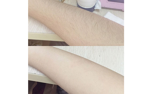 光子手臂脫毛效果怎么樣？