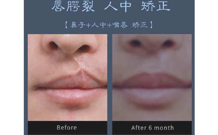 唇裂修復(fù)術(shù)需要多少錢(qián)？