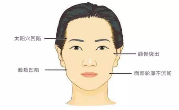 顴骨高或顴骨外擴應該怎么辦?