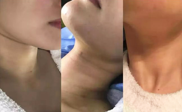激光去頸紋多少錢？