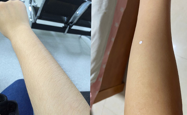 激光手臂脫毛價(jià)格貴不貴？