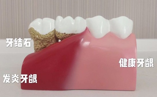 洗完牙后牙齒會變得敏感？