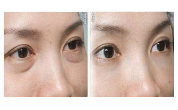 吸脂去眼袋有什么優(yōu)勢？