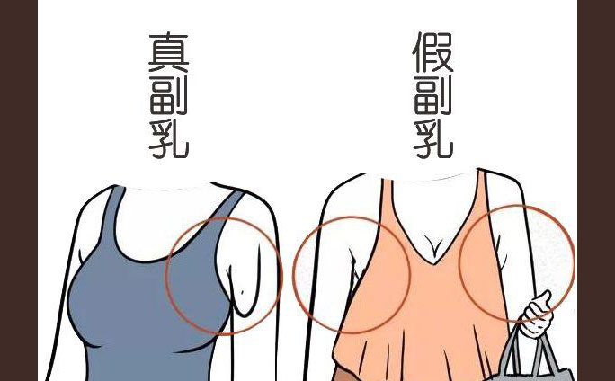 多乳癥是什么癥狀？