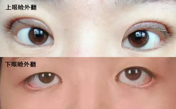 眼瞼外翻是什么導致的?眼瞼外翻怎么修復?
