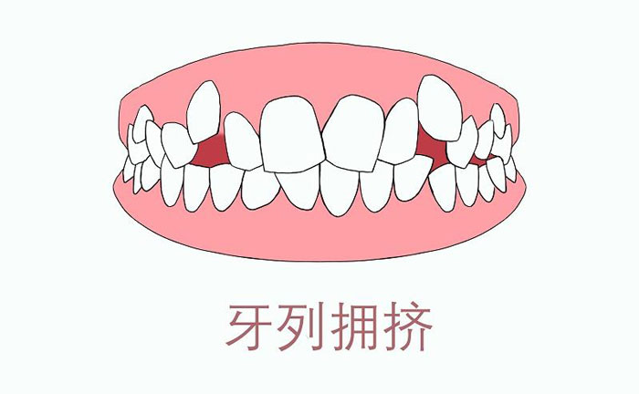 矯正牙齒擁擠度怎么算？